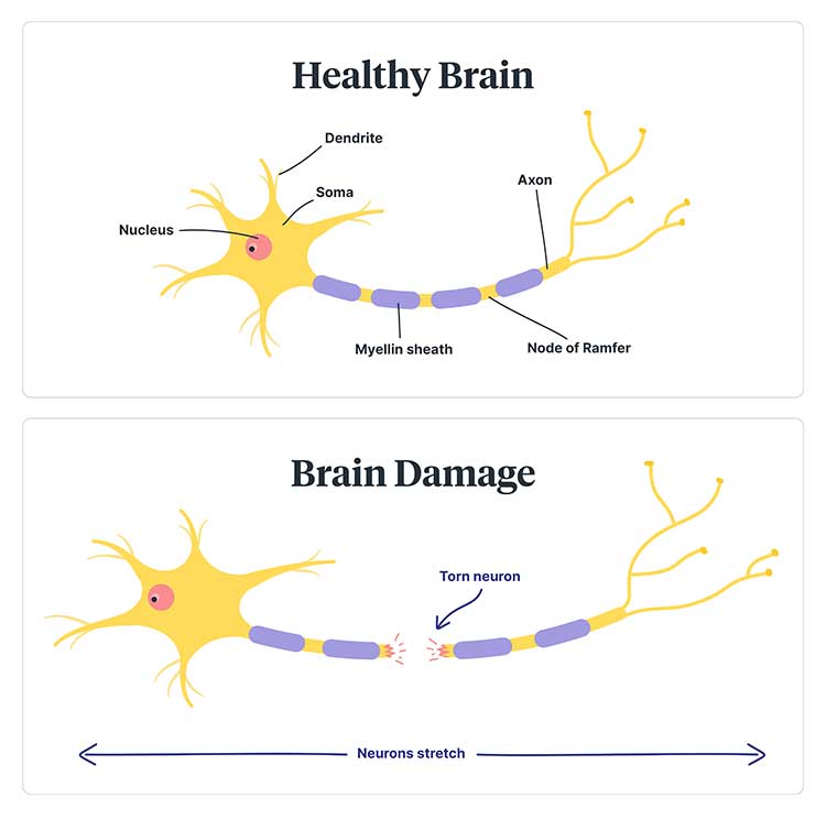 tramatic brain injury diagram