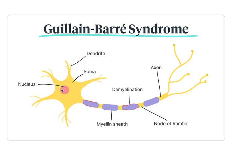 Guillain Barré syndrome diagram