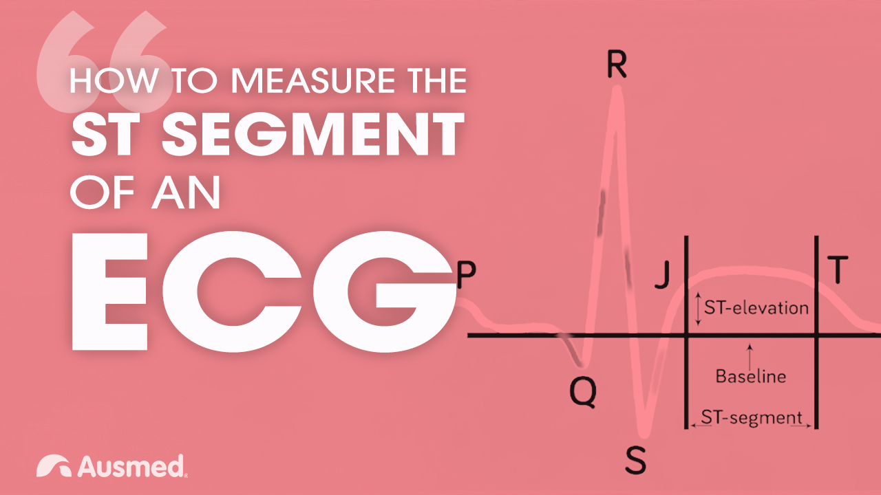 Cover image for article: How to Measure the ST Segment of an ECG