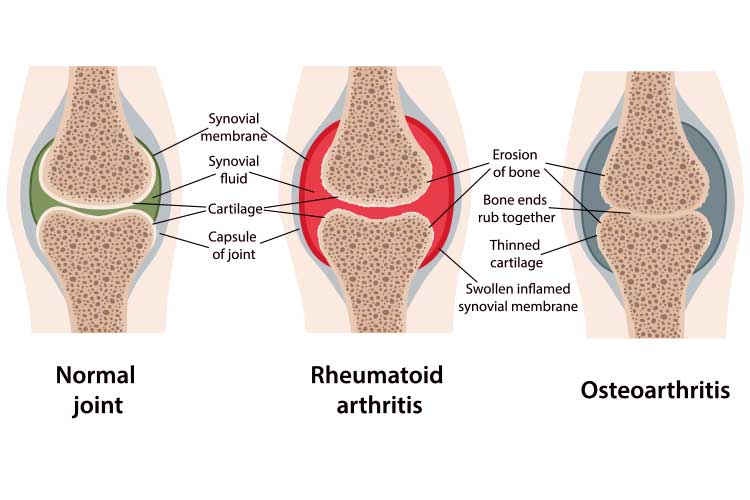 Anatomy comparison of normal, rheumatoid athoritic, and osteoartheritic joints