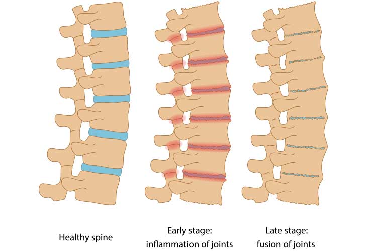 Anatomy comparison of healthy, inflamed, and fused joints