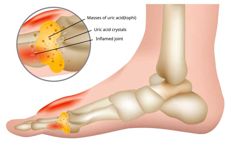 Uric acid build up in joint