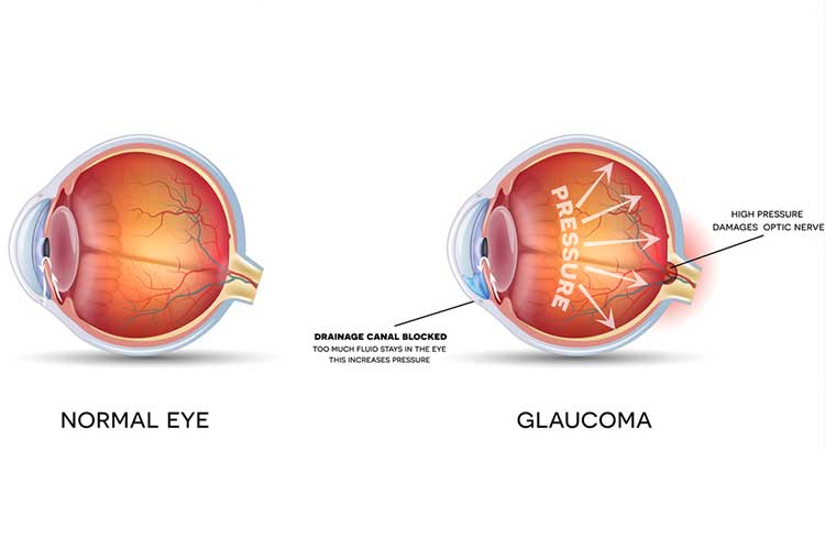 glaucoma diagram