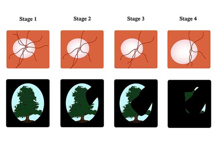 stages of glaucoma