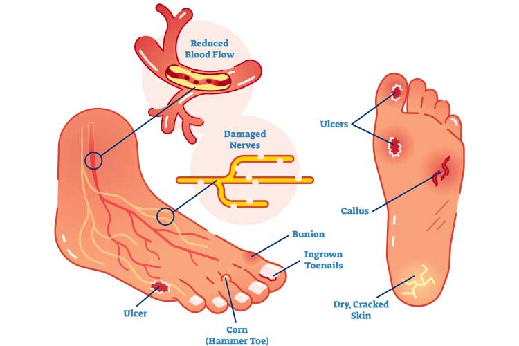 diabetic-foot-explained-ausmed