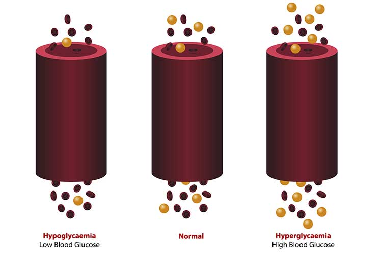 diagram hypoglycaemia compared to normal BGL and hyperglycaemia