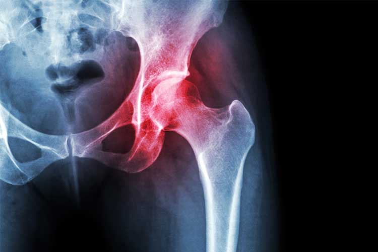 x-ray of knee with osteoarthritis
