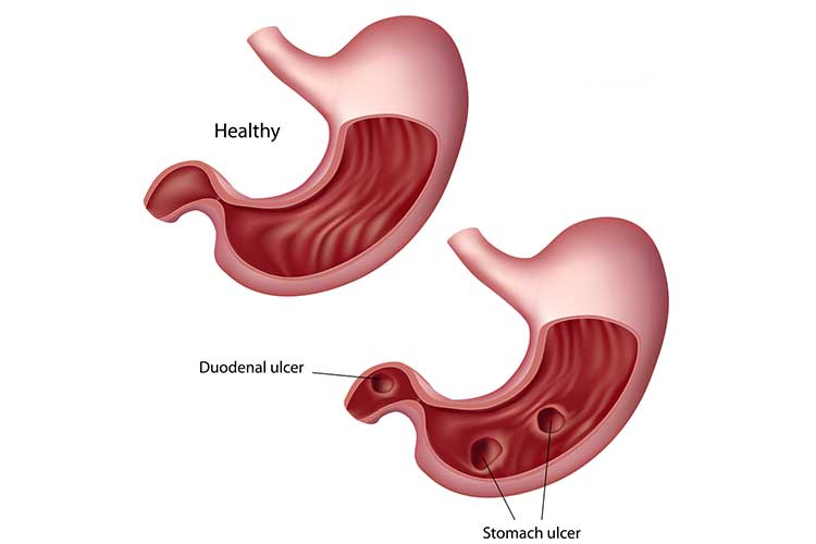 peptic ulcer diagram