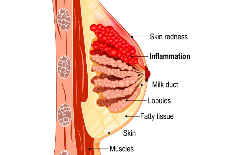 mastitis diagram