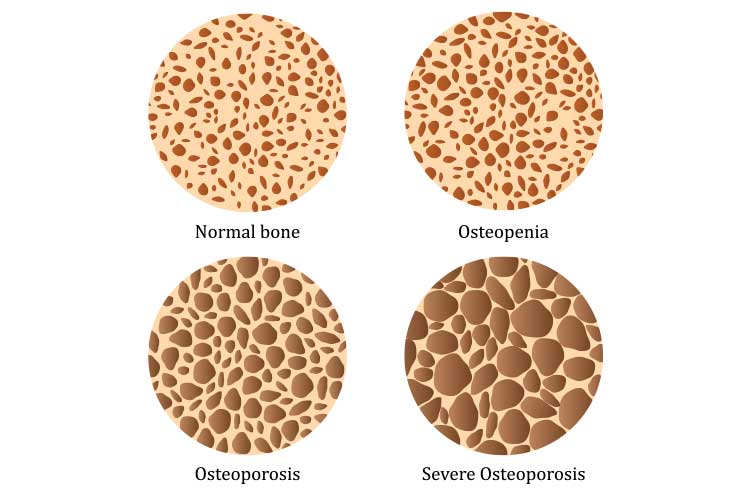 An Overview Of Osteoporosis Ausmed