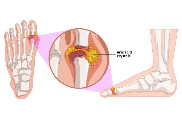 gout diagram