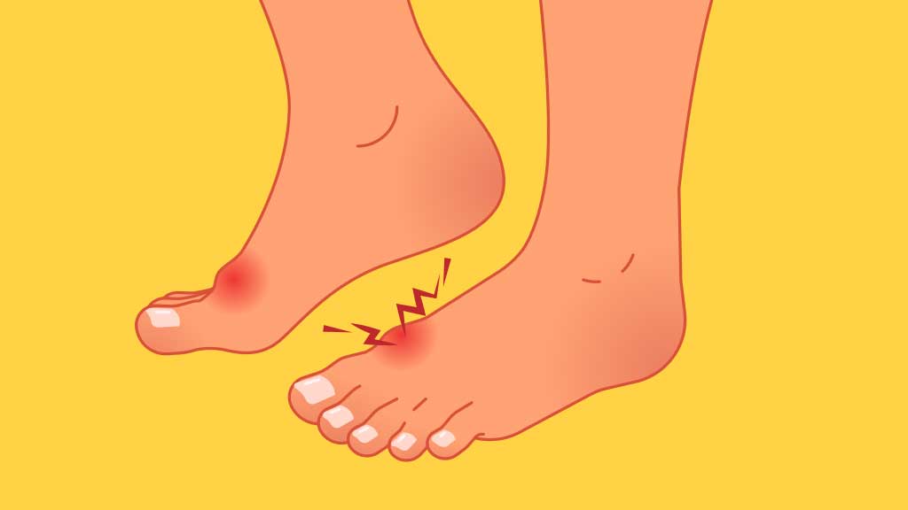 Gout Causes and Symptoms | Ausmed