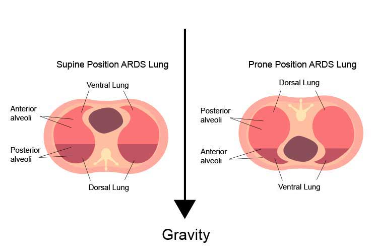 prone position v supine position ards diagram