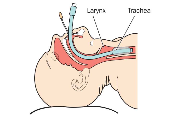 niv invasive