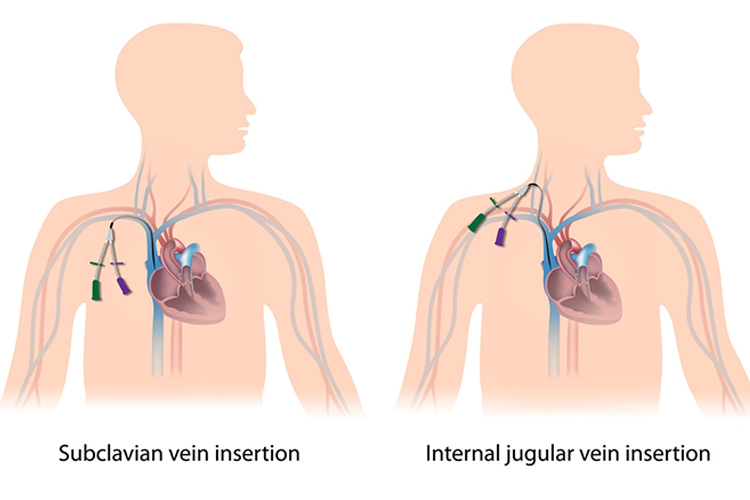 central venous catheter (CVCs) types include subclavian vein insertion and internal jugular vein insertion