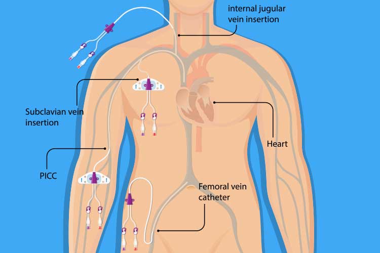 Accès veineux central en radiologie interventionnelle