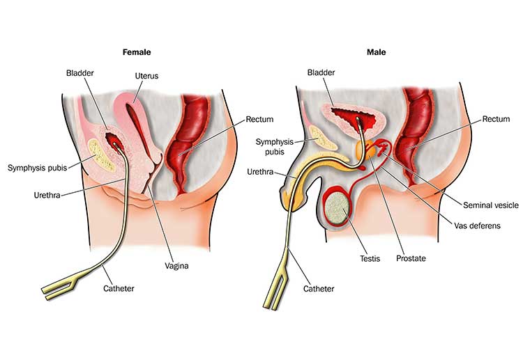 urethral catheter sizes