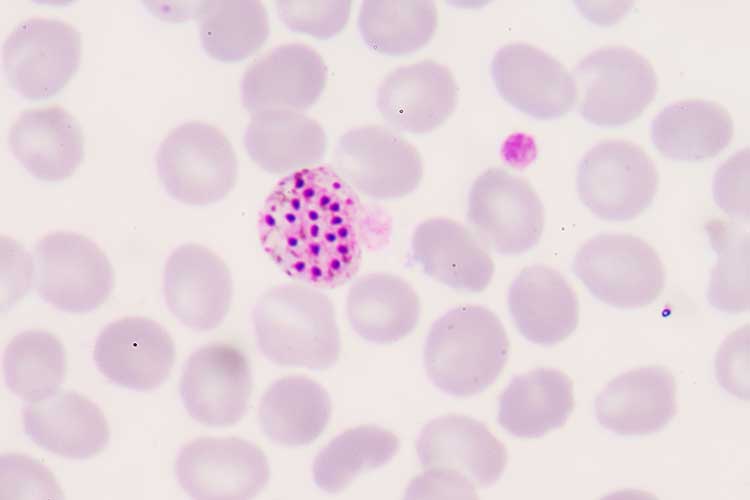malaria diagnosis