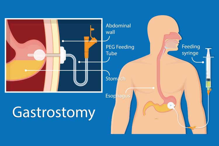 enteral feeding gastronomy diagram