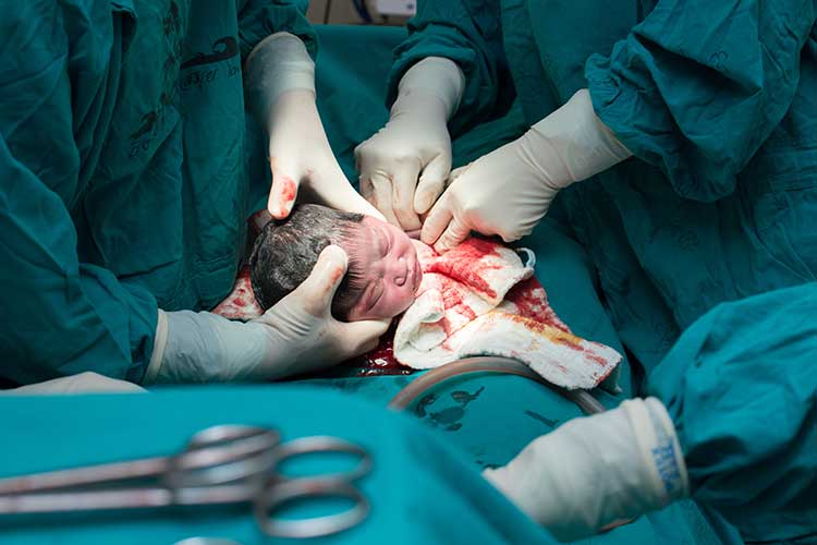 baby being delivered through cesarean birth