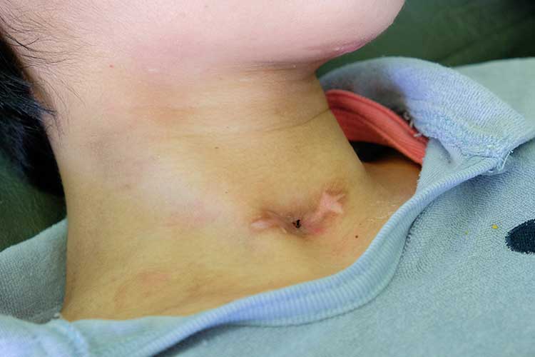 tracheostomy stoma