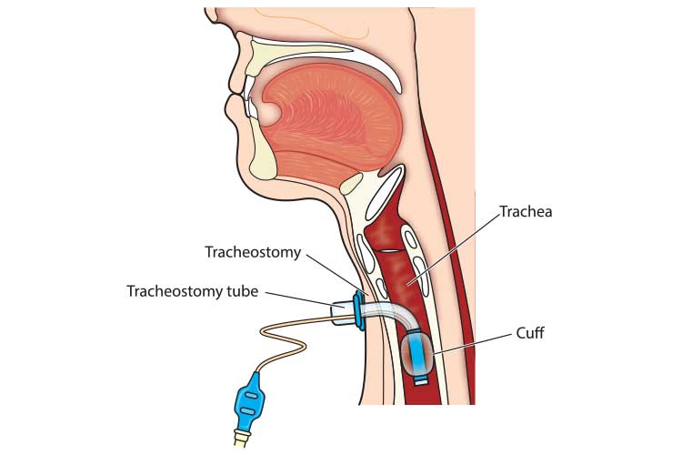 tracheostomy tube diagram