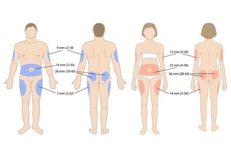 diagram of subcutaneous injection sites