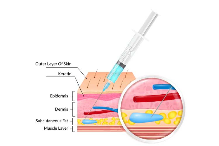 subcutaneous injection diagram