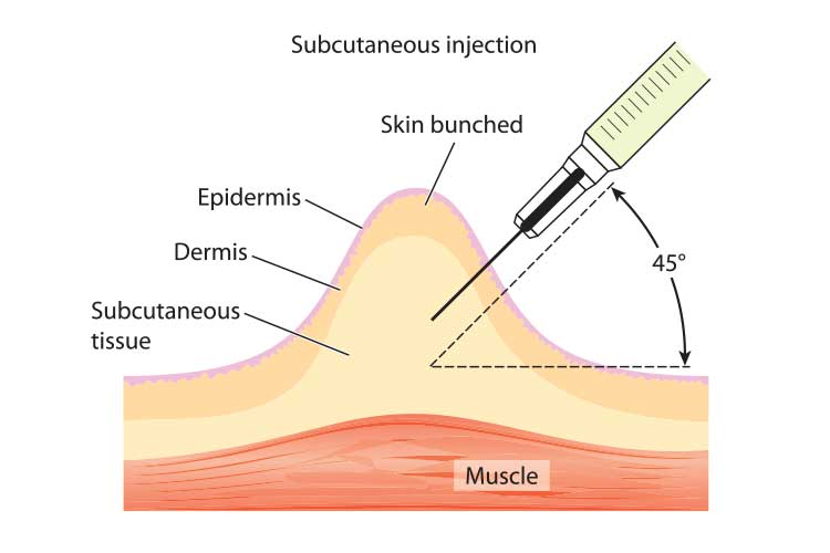 subcutaneous injection syringe insertion diagram