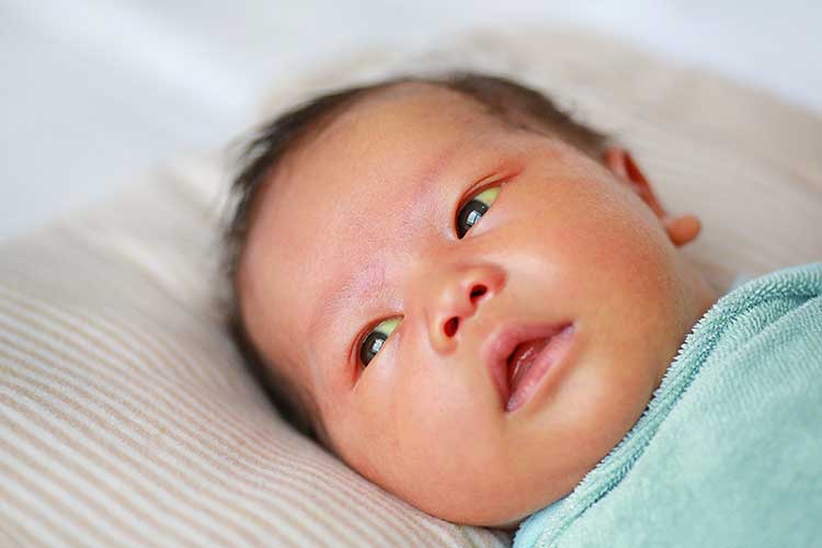 baby with neonatal jaundice