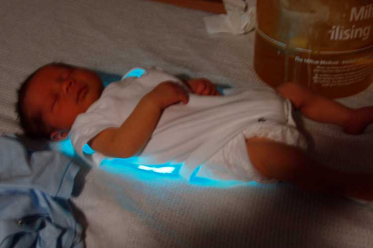baby with neonatal jaundice using biliblanket