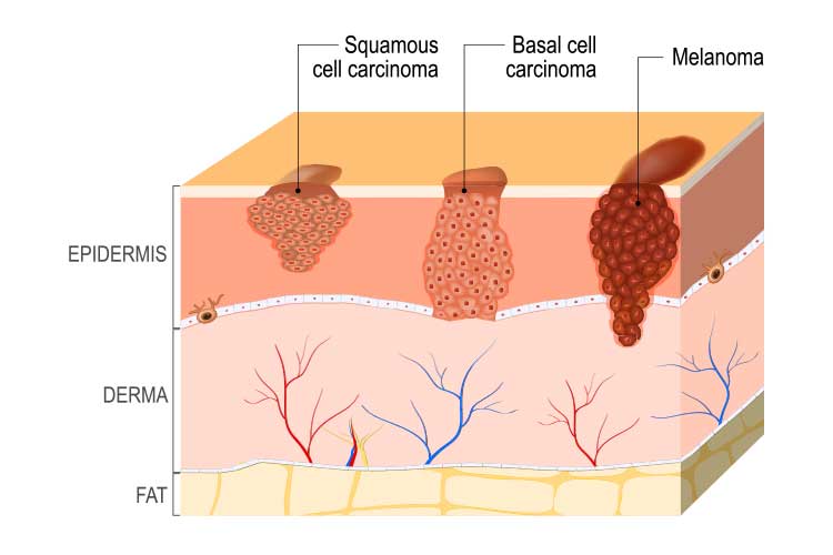 types of skin cancer diagram