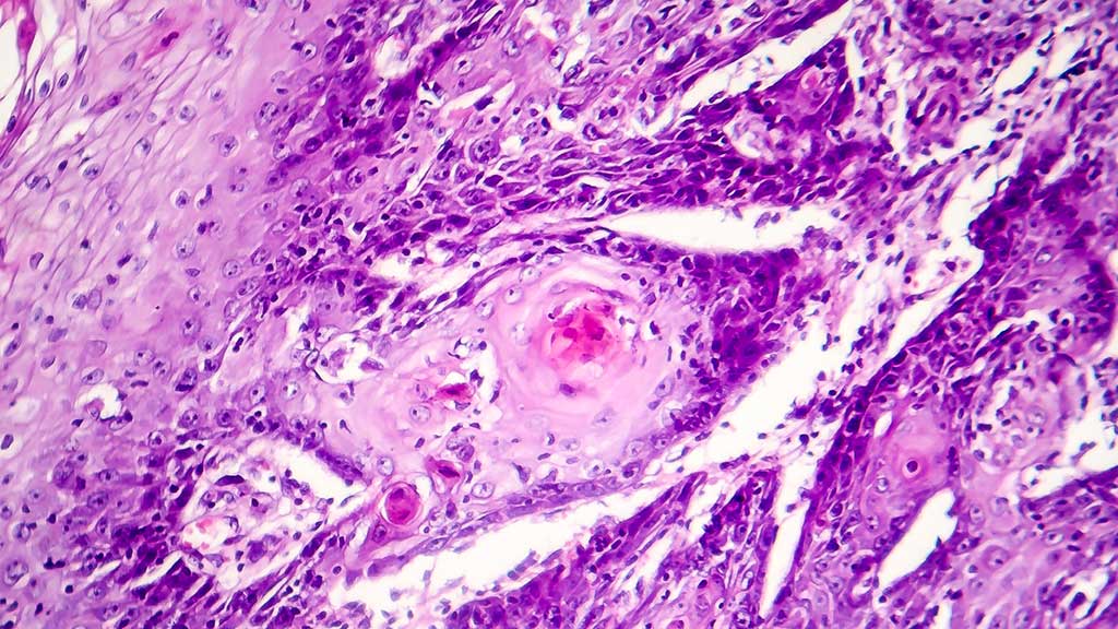 Cutaneous Squamous Cell Carcinoma (cSCC) Ausmed