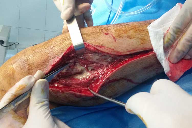 compartment syndrome
