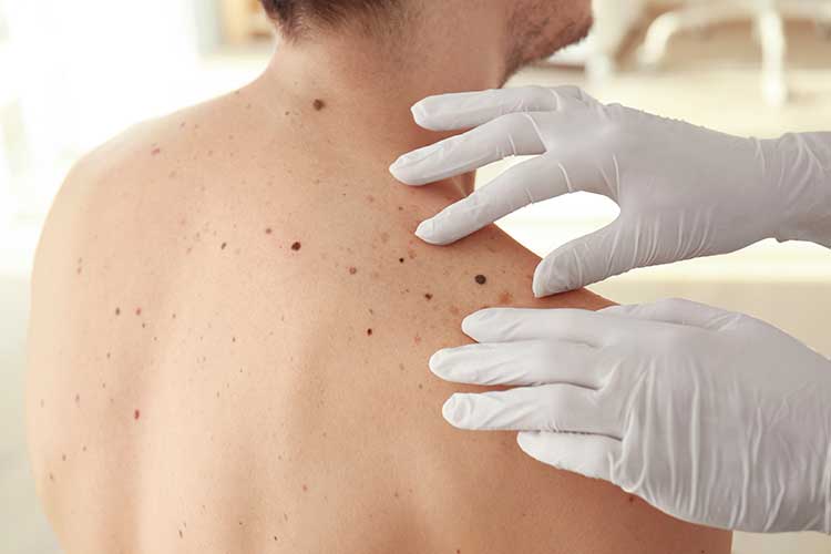 skin check for melanoma