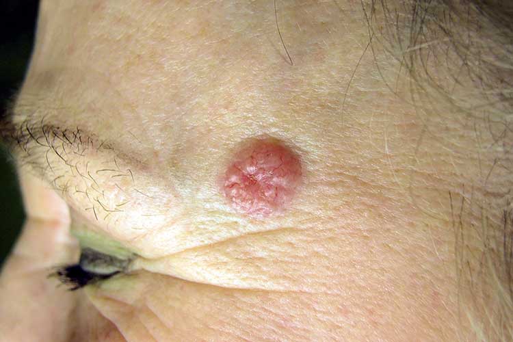 nodular basal cell carcinoma