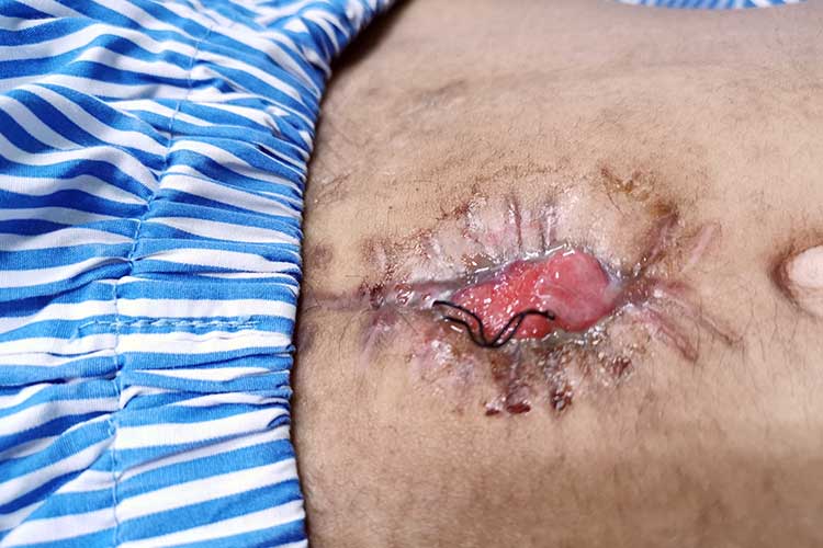 wound dehiscence on abdomen