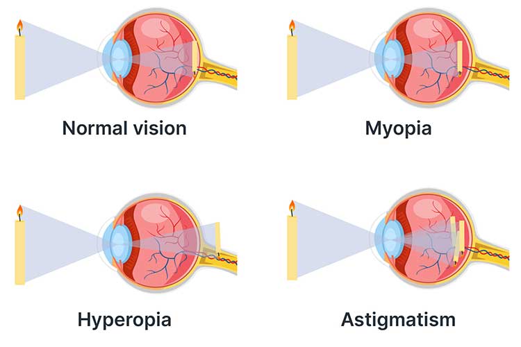 refractive errors diagrams