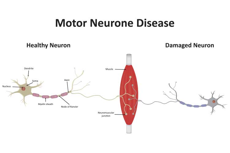 Nursing Care of Motor Neurone Disease (MND) Ausmed