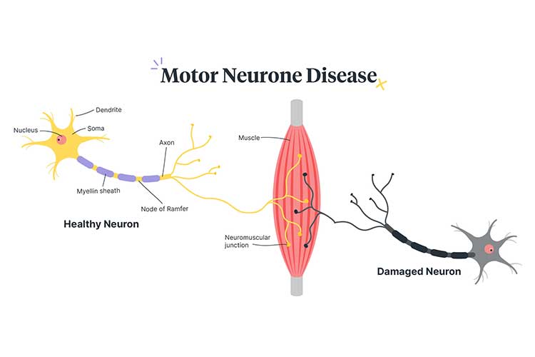 motor neurone disease diagram