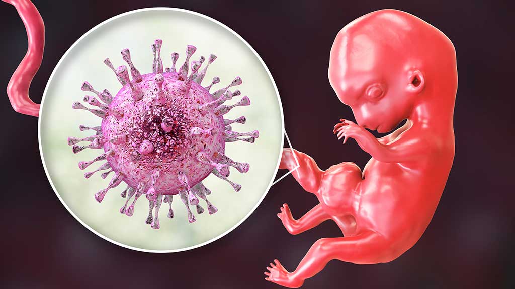 Congenital Cytomegalovirus (CMV) Reducing the Risk Ausmed