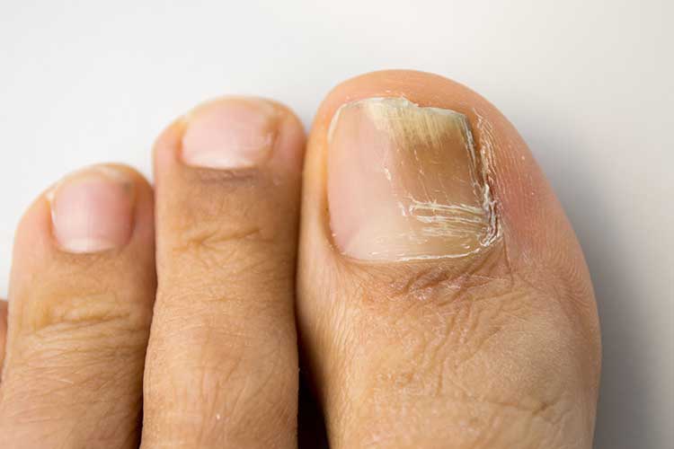 fungal nail infection