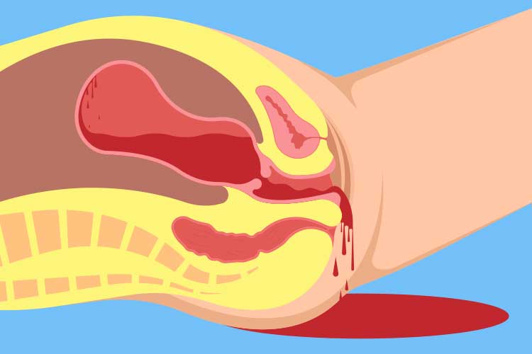 postpartum haemorrhage diagram