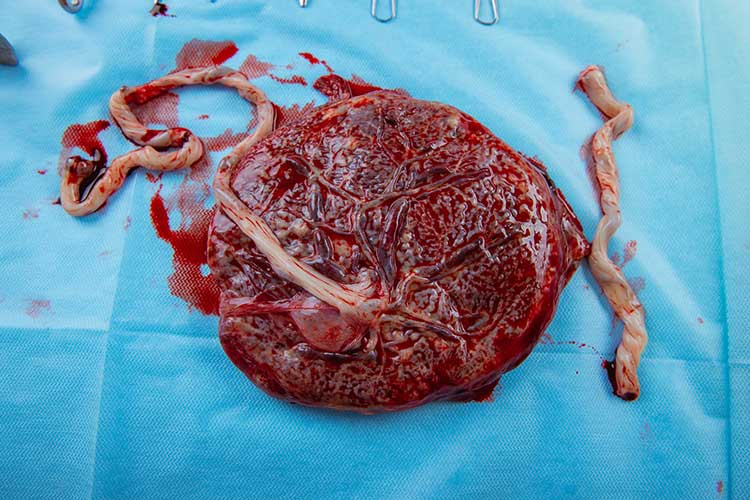 placenta after delivery