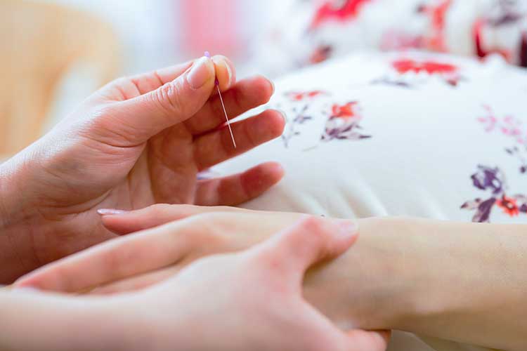 pregnant woman acupuncture