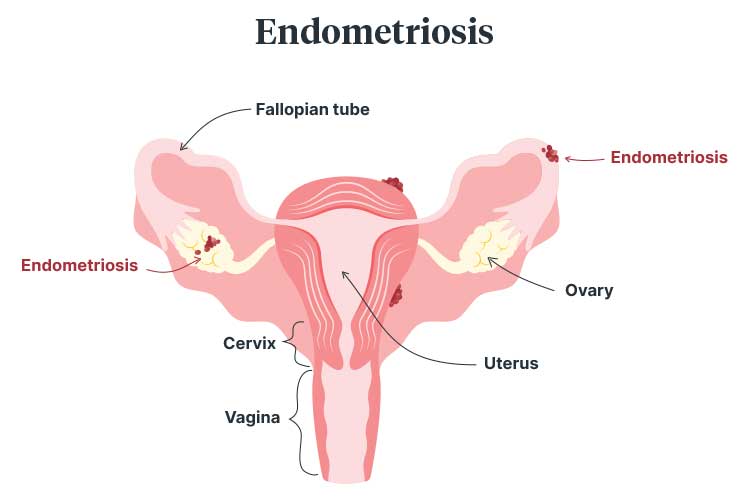 endometriosis around colon