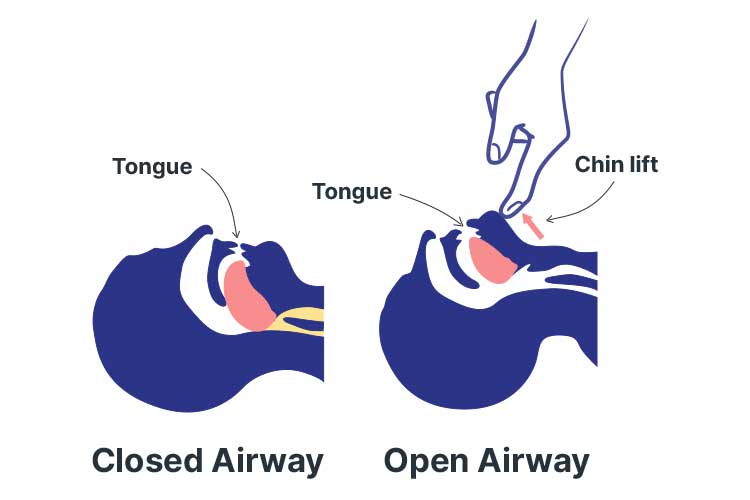 basic life support drsabcd tongue obstructing airflow