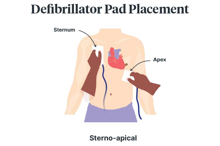 basic life support drsabcd defibrillator placement sterno-apical