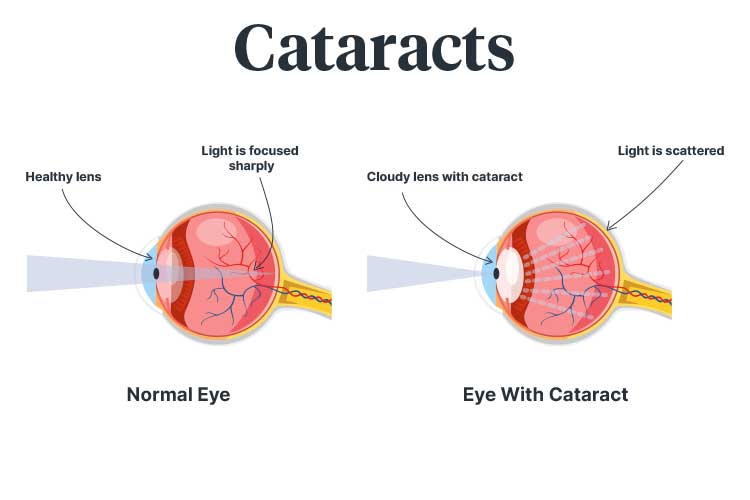 cataracts diagram