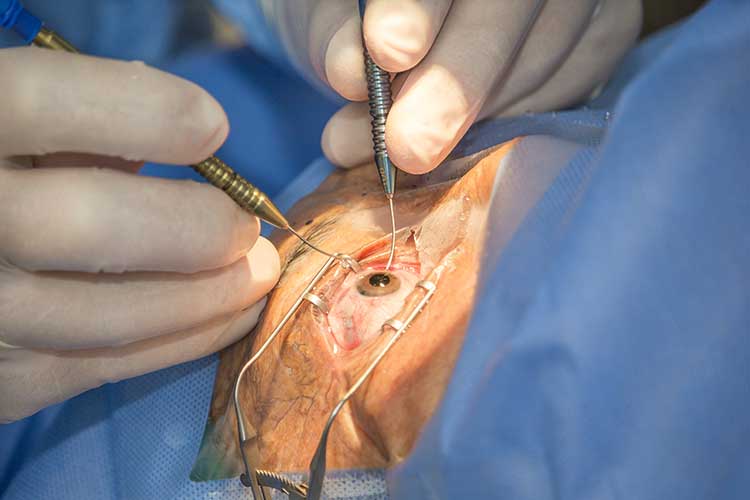 cataract surgery